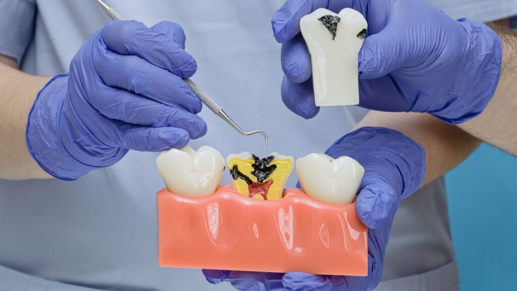 Endodoncia: Qué es, cuándo se necesita y qué cubre tu seguro dental